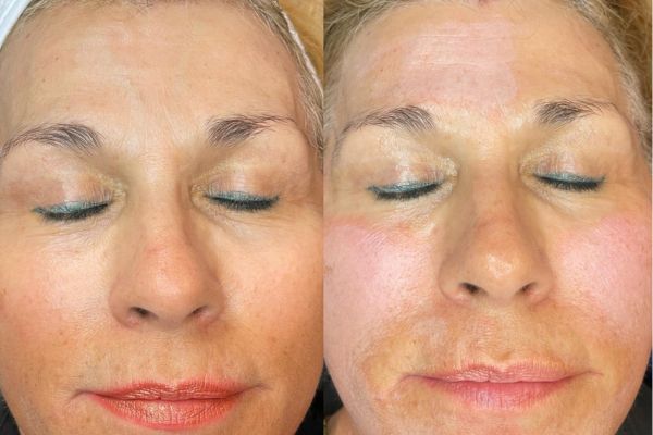 Chemical peel for dark and acne prone skin