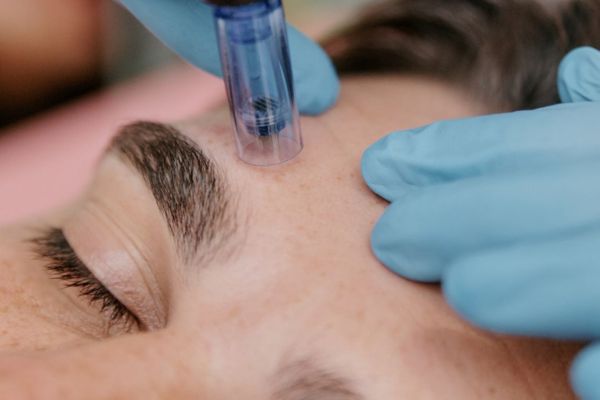 microneedlin | microneedling to remove fine lines| skincare treatment