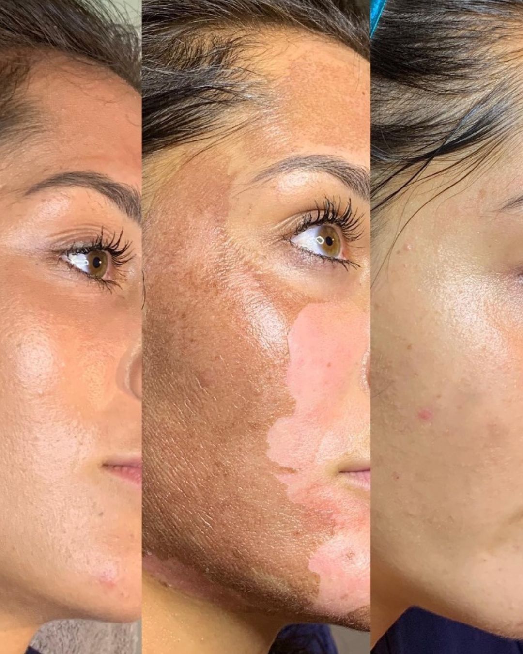 Best chemical peel choice in ornaldo | chemical peeling