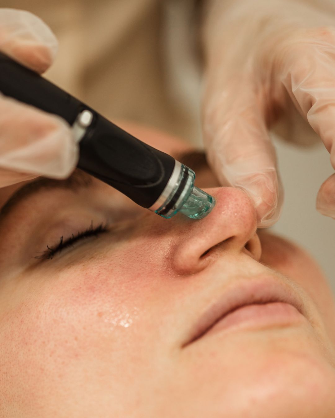 best choice hydrafacial | High rated treatment