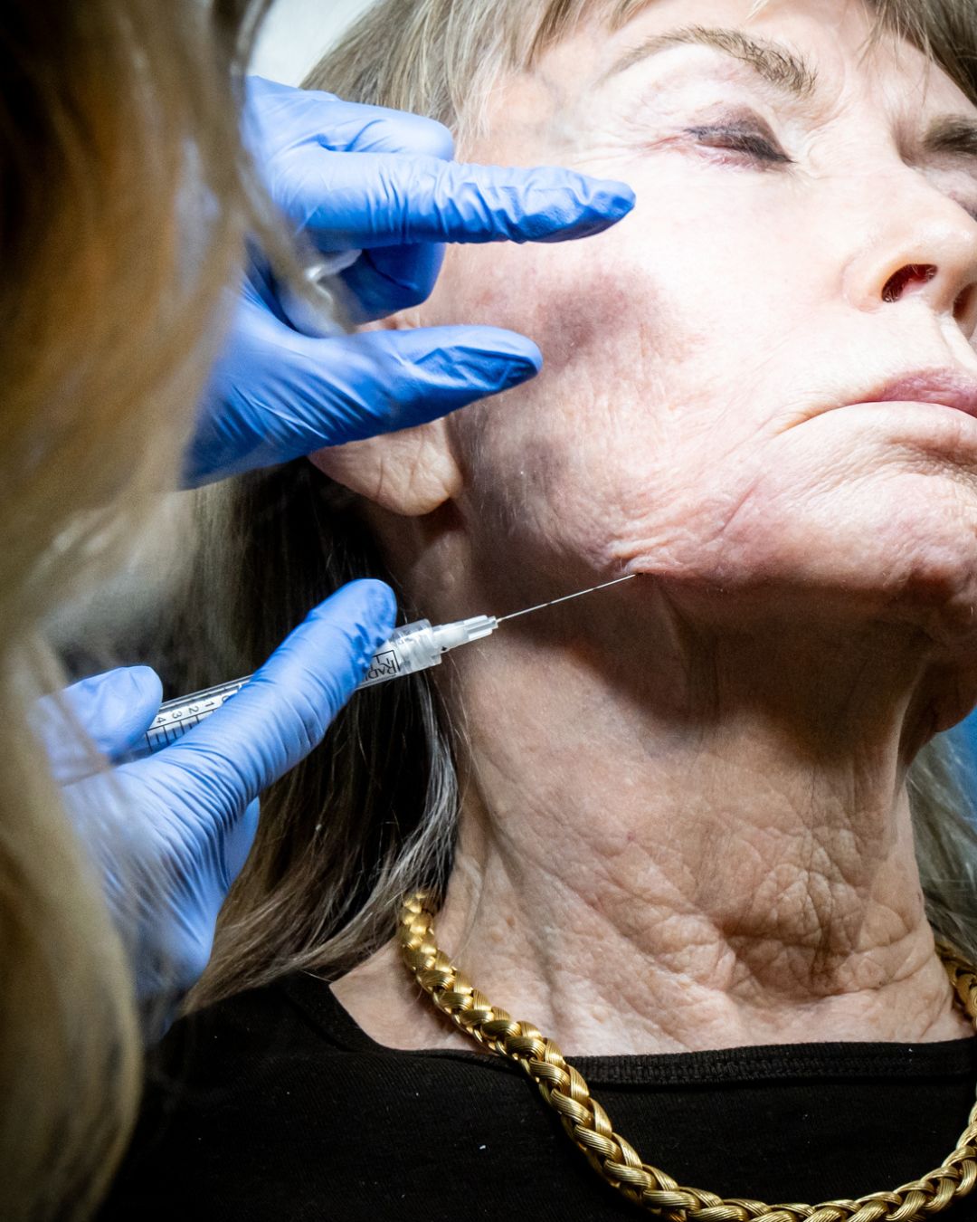 restore youthful skin | Best wrinkle and fine line treatment