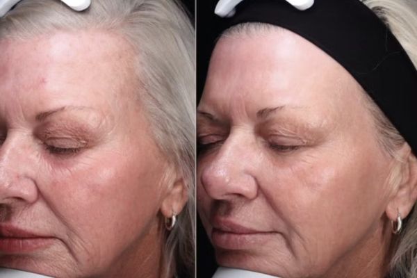 young skin | better lifestyle | beauty enhancement | finelines removal